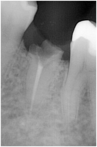 松本２　被せものの２次むし歯